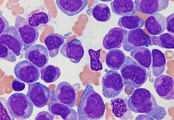 ¿Qué es la leucemia mieloide crónica?