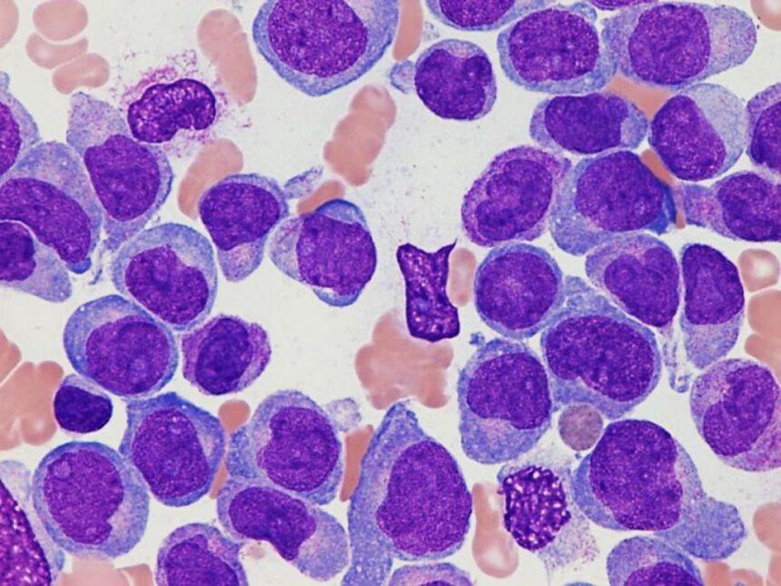 ¿Qué es la leucemia mieloide crónica?