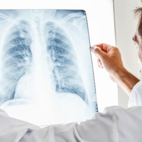 Lo que debes saber sobre el cáncer de pulmón