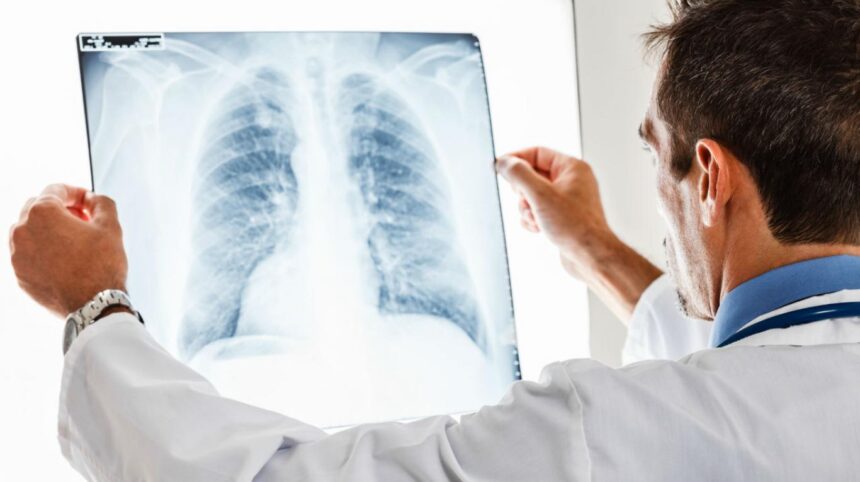 Lo que debes saber sobre el cáncer de pulmón