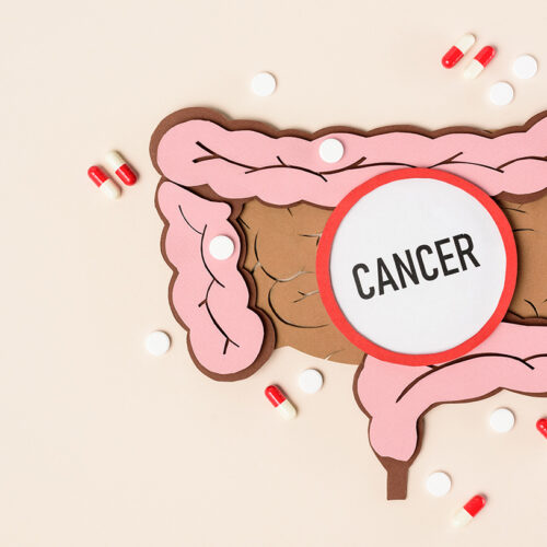 El cáncer de colon es un reto para todos, seamos conscientes de esta enfermedad.