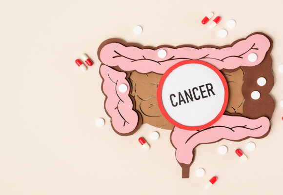 El cáncer de colon es un reto para todos, seamos conscientes de esta enfermedad.